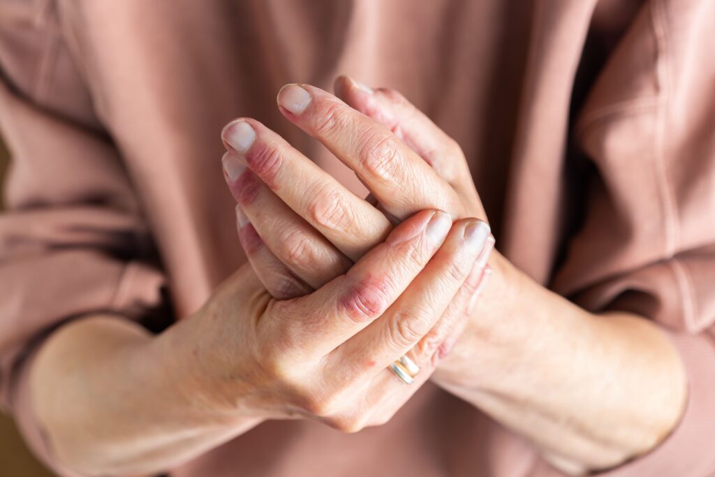 person holding their hands with eczema