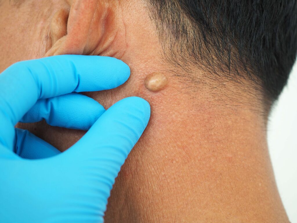 up close doctor squeezing cyst with glove