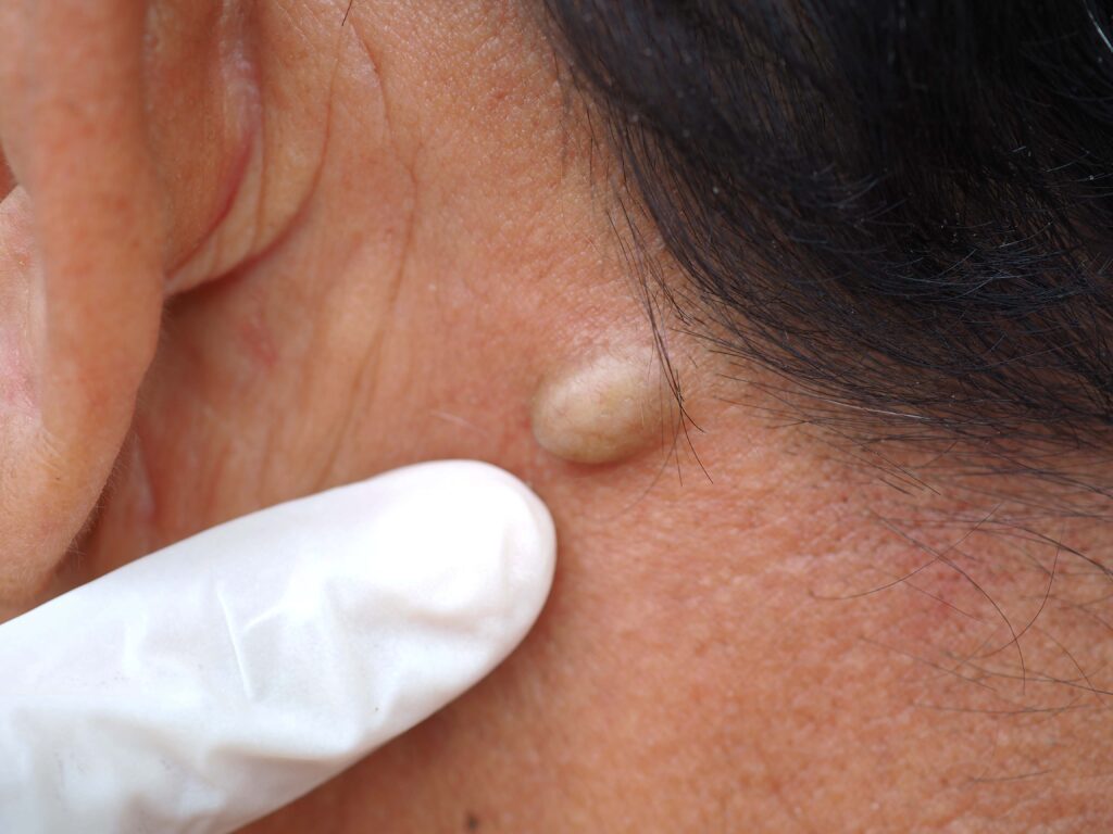 cysts
